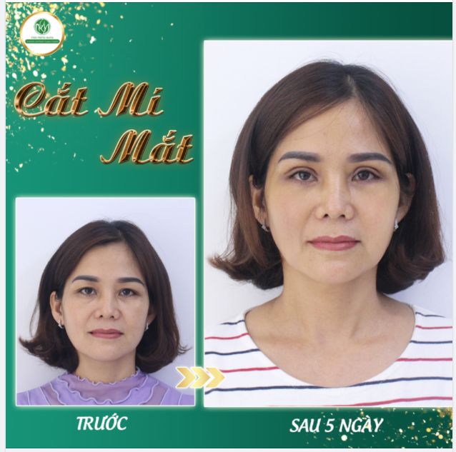GIẢI CỨU ĐÔI MẮT SỤP MÍ - MẮT 2 MÍ TRẺ TRUNG SAU 5 NGÀY