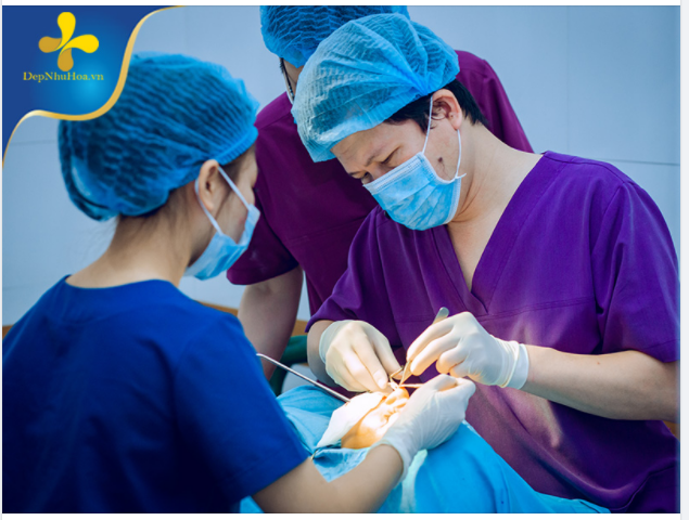 GIẢI ĐÁP 4 CÂU HỎI THƯỜNG GẶP VỀ THU GỌN CÁNH MŨI