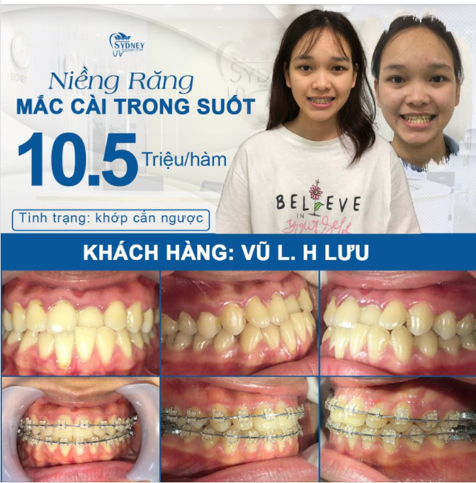 GIẢI QUYẾT HOÀN TOÀN KHỚP CẮN NGƯỢC