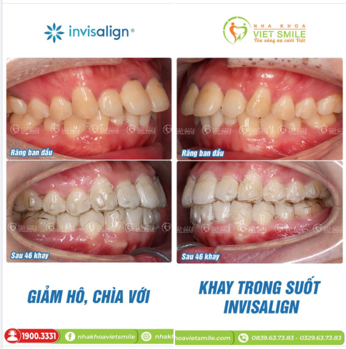 GIẢM HÔ, CHÌA VỚI KHAY TRONG SUỐT INVISALIGN