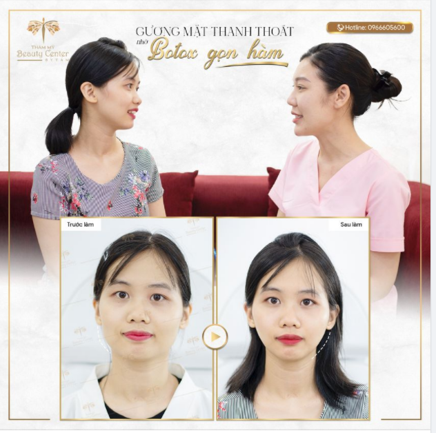 GƯƠNG MẶT THANH THOÁT NHỜ BOTOX GỌN HÀM