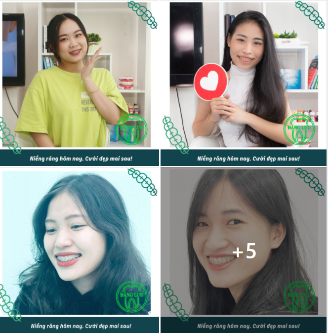 Hàng triệu người sẵn sàng niềng răng để có được nụ cười đẹp hơn, tự tin hơn, hàm răng đều & khớp cắn chuẩn hơn!