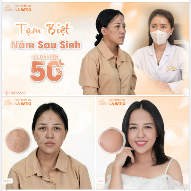 HẾT 98% NÁM, RŨ BỎ ÁM ẢNH NÁM SAU SINH VỚI PICO LASER