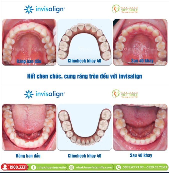 HẾT CHEN CHÚC, CUNG RĂNG TRÒN ĐỀU VỚI INVISALIGN