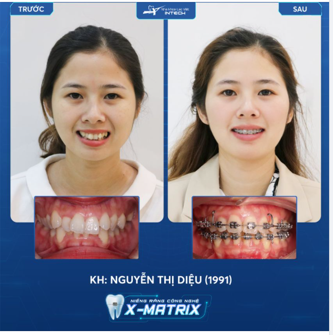 HẾT KHẤP KHỂNH - TỰ TIN CƯỜI NHỜ NIỀNG RĂNG CÔNG NGHỆ X-MATRIX
