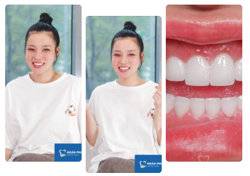 Hiện thực hóa ước mơ sở hữu hàm răng đều đẹp nhanh chóng, an toàn cho chị khách với răng sứ thẩm mỹ