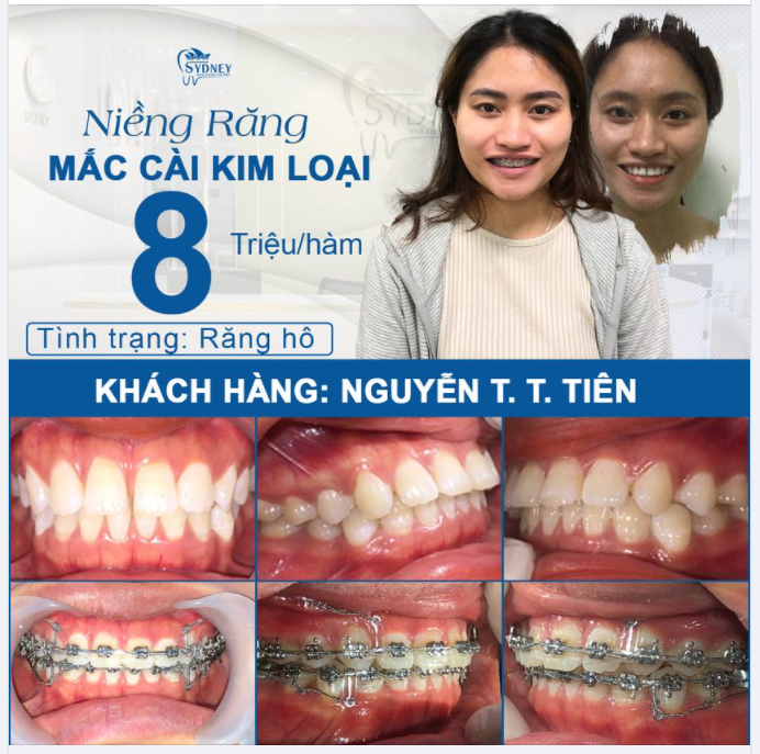 HÔ THƯA KẾT HỢP - KHẮC PHỤC NHƯ NÀO 