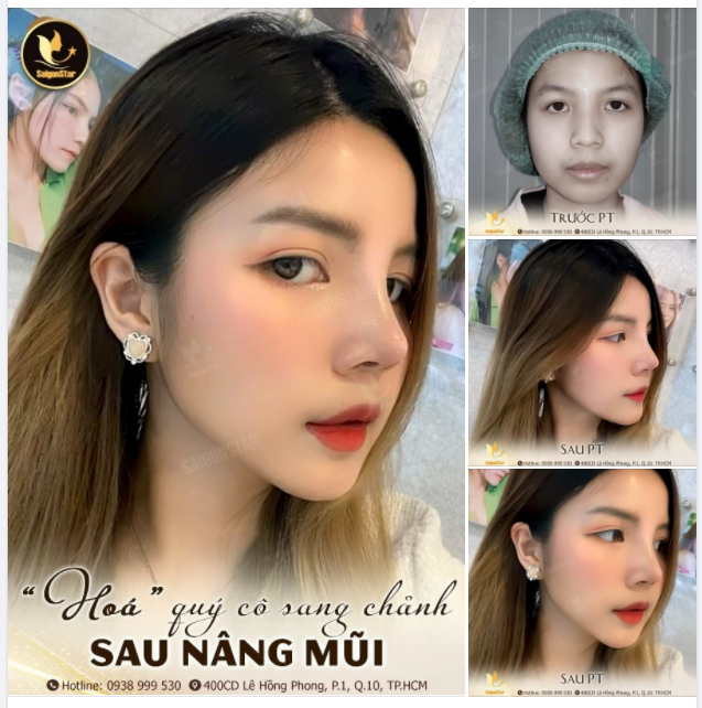 HÓA QUÝ CÔ SANG CHẢNH SAU NÂNG MŨI