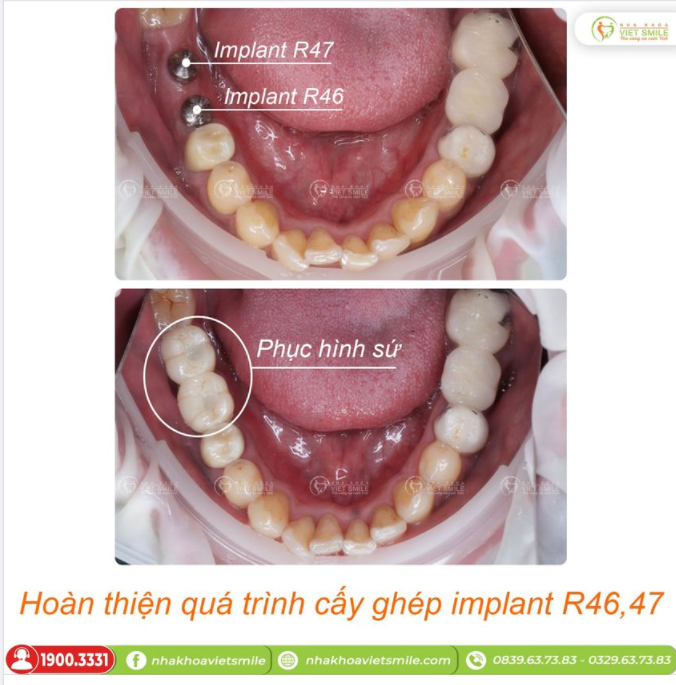 HOÀN THIỆN QUÁ TRÌNH CẤY GHÉP IMPLANT RĂNG 46,47
