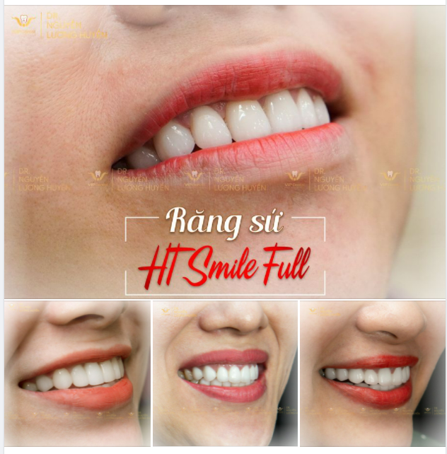 HT SMILE FULL - NỤ CƯỜI THĂNG HẠNG NHAN SẮC