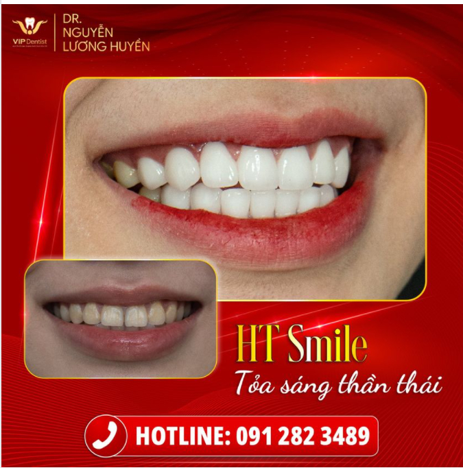 HT SMILE - NỤ CƯỜI “TỶ LỆ VÀNG” SẴN SÀNG CÙNG NÀNG TỎA SÁNG