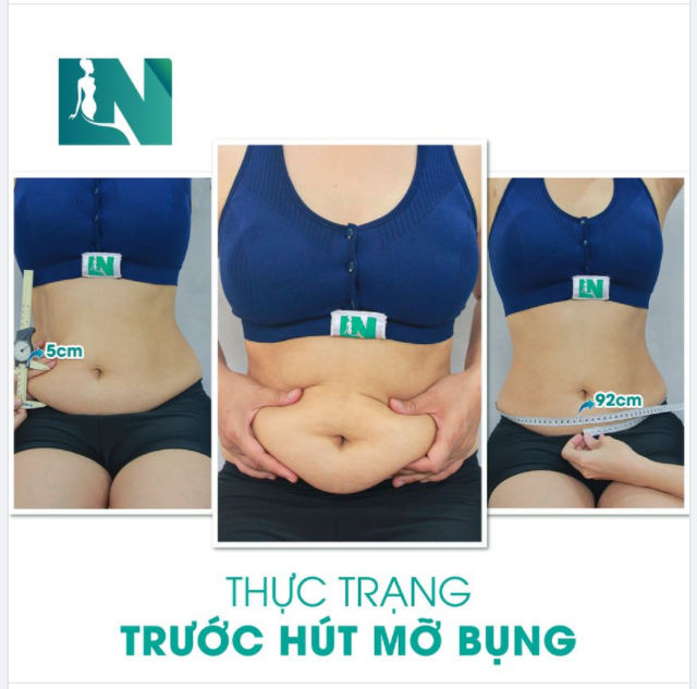  HÚT MỠ BỤNG KẾT HỢP CẤY MỠ NGỰC, LẤY LẠI DÁNG VÓC CHO BÀ MẸ 2 CON 36 TUỔI, ĐÃ TỪNG TIÊM TAN MỠ.