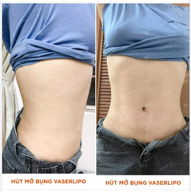 Hút mỡ bụng VASERlipo không lo sẹo xấu và loại bỏ đến 95% mỡ thừa chỉ sau 1 lần thực hiện.