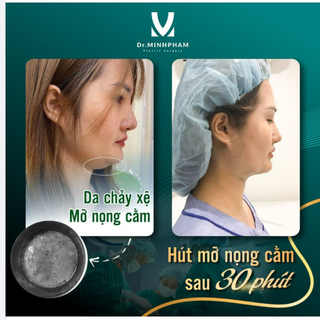 HÚT MỠ NỌNG CẰM - THẮM LẠI THANH XUÂN