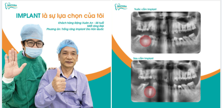 IMPLANT CHÍNH LÀ SỰ LỰA CHỌN CỦA TÔI KHI MẤT RĂNG !