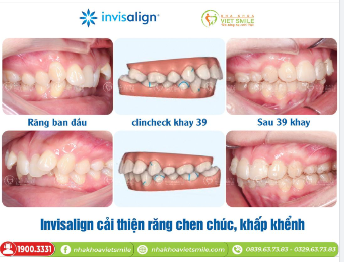 INVISALIGN CẢI THIỆN RĂNG CHEN CHÚC, KHẤP KHỂNH