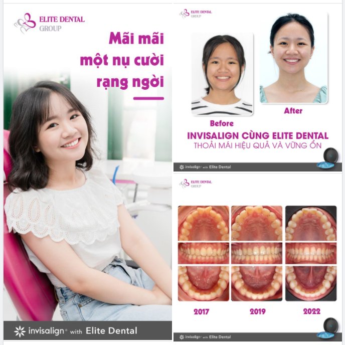 INVISALIGN GIẢI CẮN SÂU VÀ HÀNH TRÌNH ỔN ĐỊNH SAU 3 NĂM KẾT THÚC