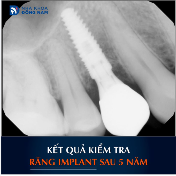 KẾT QUẢ KIỂM TRA IMPLANT SAU 5 NĂM