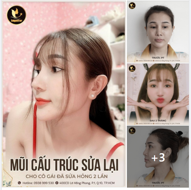 KẾT QUẢ NÂNG MŨI CẤU TRÚC SỬA LẠI SAU 2 THÁNG