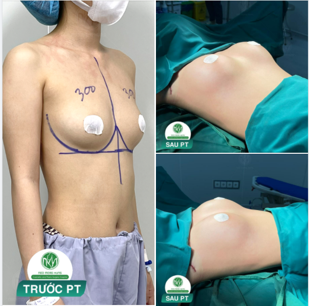 KẾT QUẢ SAU NÂNG NGỰC CHO CÔ GÁI LÀ NGƯỜI MẪU ẢNH