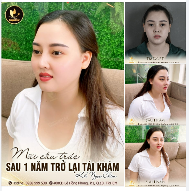 KH NÂNG MŨI CẤU TRÚC SAU 1 NĂM TRỞ LẠI TÁI KHÁM