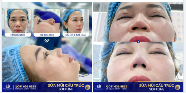 KH từ Bắc Giang đến với bác sĩ Vũ Quang để giải cứu chiếc mũi hỏng do làm tại spa cỏ