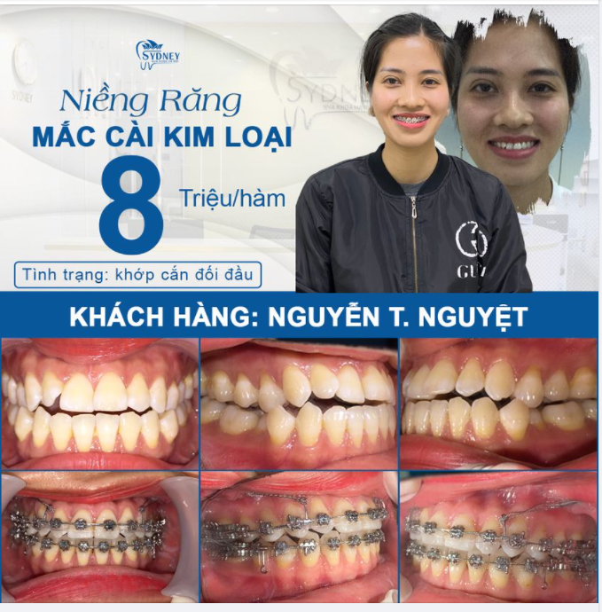 KHẮC PHỤ HIỆU QUẢ KHỚP CẮN ĐỐI ĐẦU