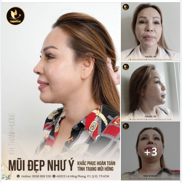 KHẮC PHỤC HOÀN TOÀN MŨI HỎNG TRƯỚC ĐÓ - CÓ NGAY MŨI ĐẸP NHƯ Ý