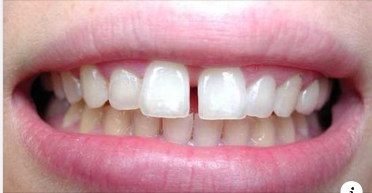 Khắc phục khe hở giữa hai răng cửa