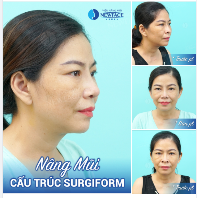 KHẮC PHỤC LỖ MŨI “TIỀN RA” NHỜ NÂNG MŨI CẤU TRÚC