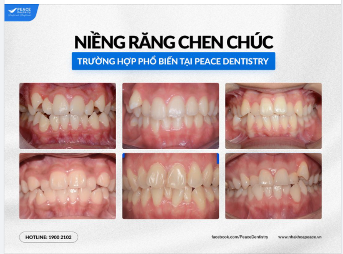 KHẮC PHỤC RĂNG CHEN CHÚC CÓ THỂ NHANH HƠN BẠN NGHĨ !