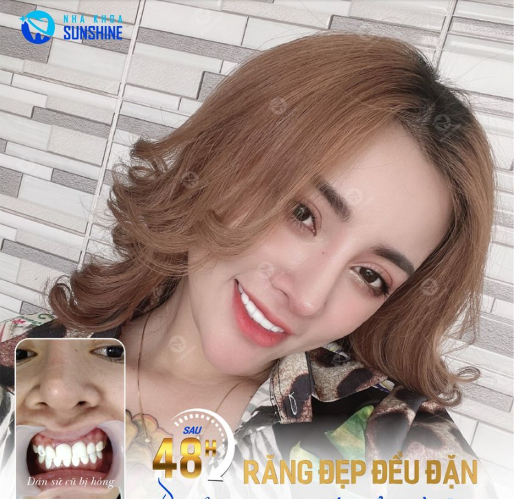 KHẮC PHỤC RĂNG DÁN SỨ BỊ HỎNG NHANH CHÓNG, HIỆU QUẢ