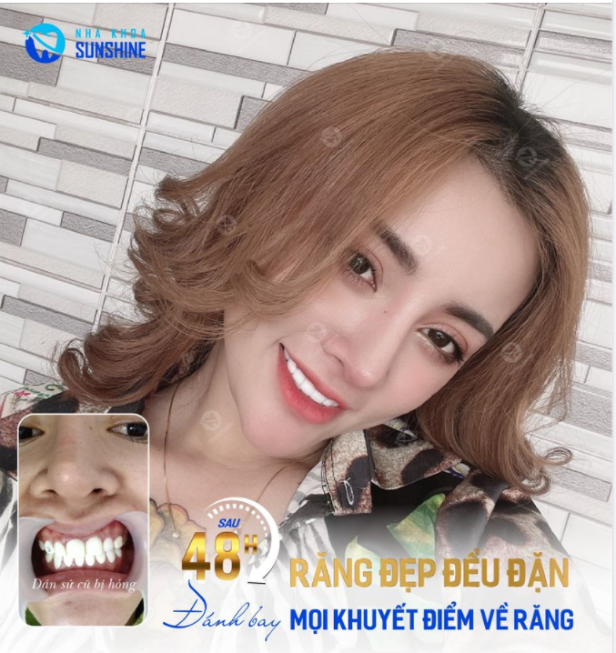 KHẮC PHỤC RĂNG DÁN SỨ BỊ HỎNG NHANH CHÓNG, HIỆU QUẢ