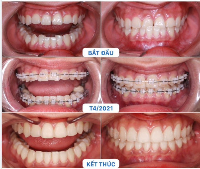 KHẮC PHỤC RĂNG MÓM NHỜ NIỀNG RĂNG CÔNG NGHỆ X-MATRIX