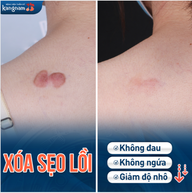 Khách hàng điều trị sẹo lồi thành công sau 3 buổi