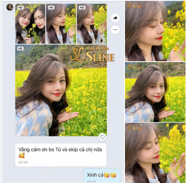 Khách hàng nâng mũi cấu trúc với ekip Sline, dáng mũi thon cao phù hợp với gương mặt.