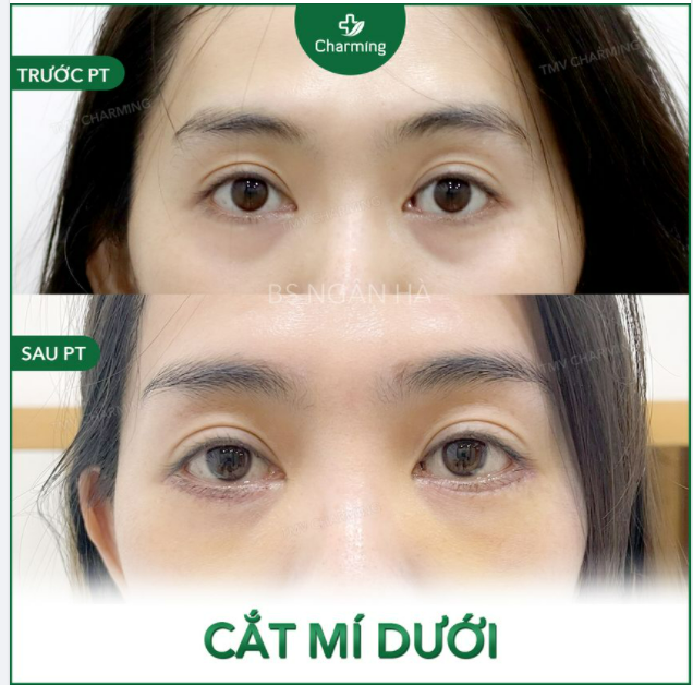Khi bọng mắt to mà khuôn mặt vẫn ngời nét tươi trẻ thì bạn vẫn có thể chọn phẫu thuật cắt mí dưới với Bs Hà.
