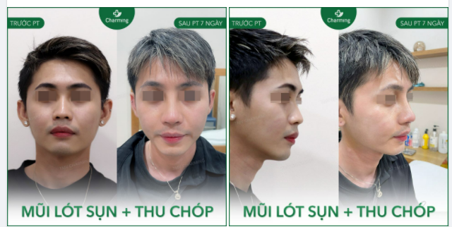 Khi mũi bạn chưa đẹp Nâng mũi lót sụn sẽ khiến nó đẹp tự nhiên.