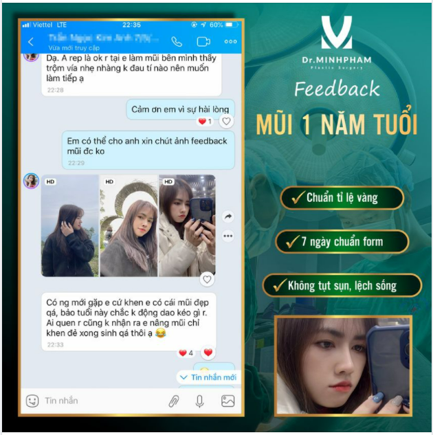 Không ai biết mình nâng mũi mà mọi người chỉ nói sinh bé xong trông xinh hơn