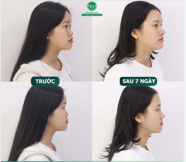 KHÔNG CÒN NHẬN RA KH SAU 7 NGÀY NÂNG MŨI