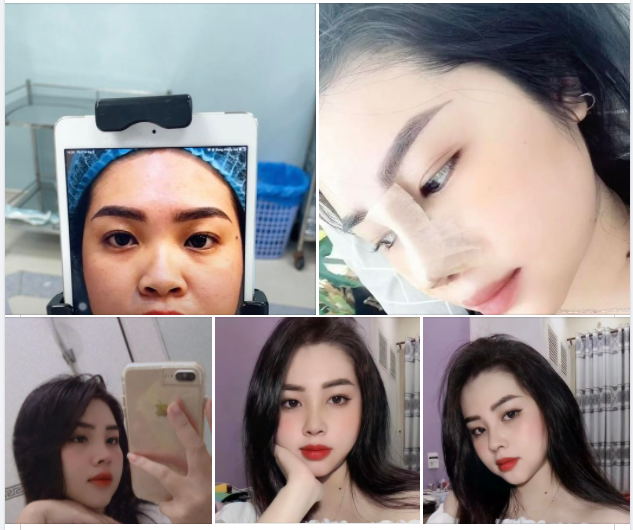 KHÔNG NHẬN RA MÌNH SAU NÂNG MŨI CẤU TRÚC NHƯNG ĐẸP VÀ ƯNG Ý LÀ ĐƯỢC ĐÚNG KHÔNG CẢ NHÀ!
