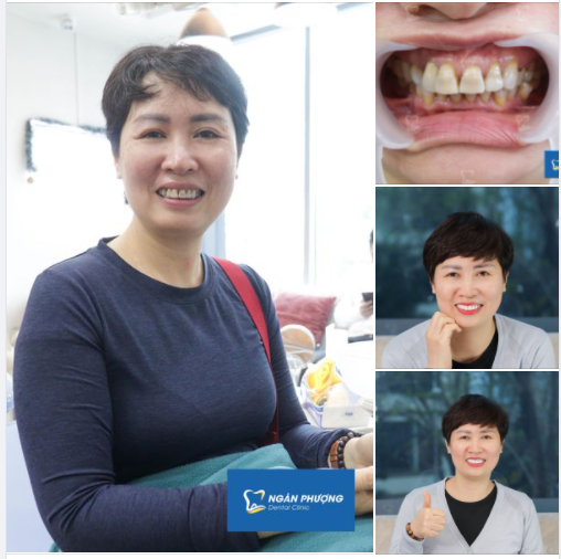 Không thể tin nổi, làm răng giúp trẻ hơn là có thật