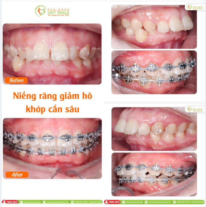 Khớp cắn sâu là tình trạng sai khớp cắn khá nghiêm trọng, dù là trường hợp nặng hay nhẹ thì đều gây ảnh hưởng đều sức khỏe, thẩm mỹ.