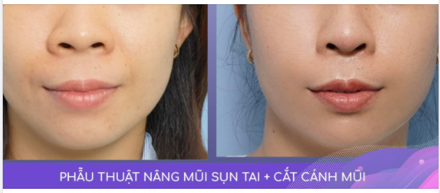 KHUÔN MẶT CHUẨN “TỈ LỆ VÀNG” NHỜ THU GỌN CÁNH MŨI