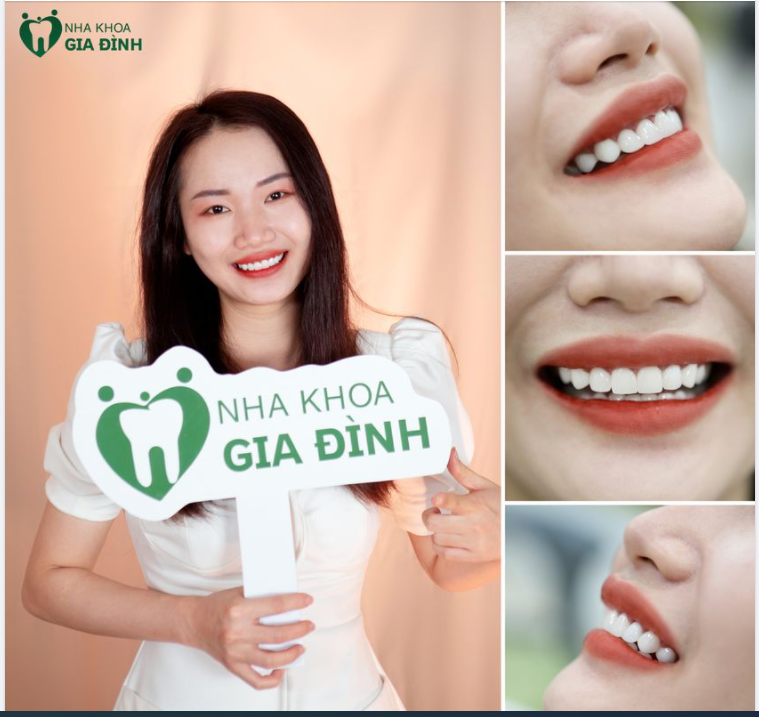 KHUÔN RĂNG TỰ NHIÊN – TRẮNG SÁNG TỰ TIN