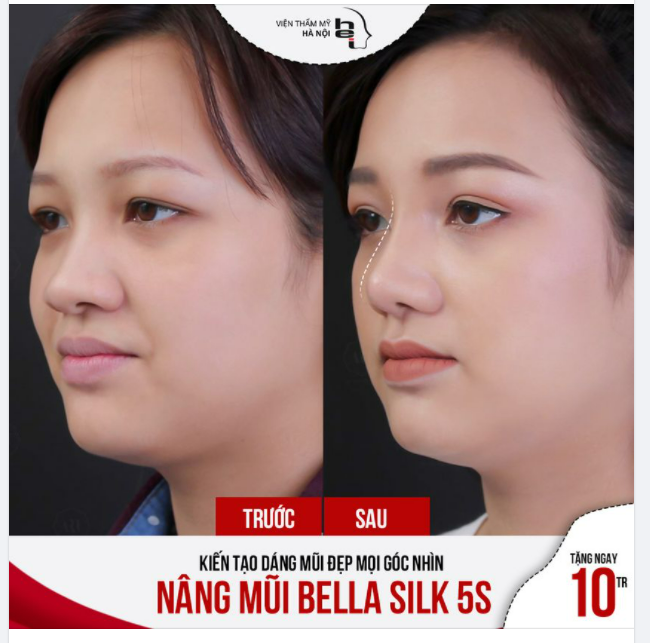 KIẾN TẠO DÁNG MŨI ĐẸP MỌI GÓC NHÌN