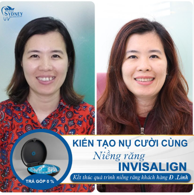 KIẾN TẠO NỤ CƯỜI CÙNG INVISALIGN