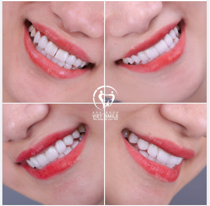 KIẾN TẠO NỤ CƯỜI ĐẸP TỰ NHIÊN CÙNG BỌC SỨ THẨM MỸ