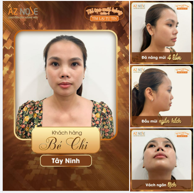 Kiên trì tìm kiếm cơ hội sau 4 lần nâng mũi bị lỗi...