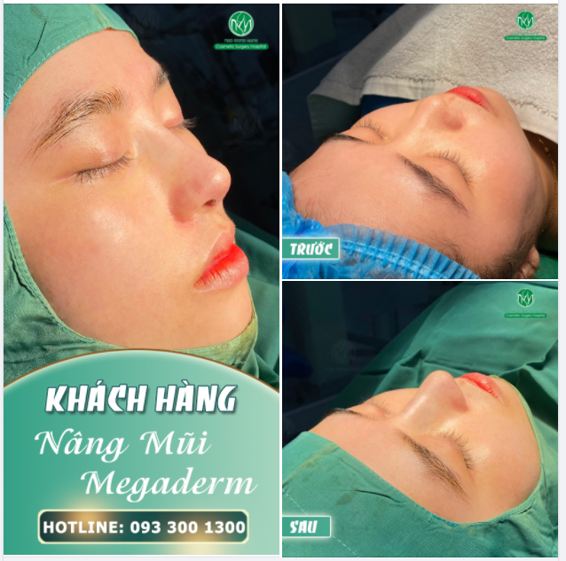 LẠI LÀ MỘT DÁNG MŨI ĐẸP SAU PHẪU THUẬT